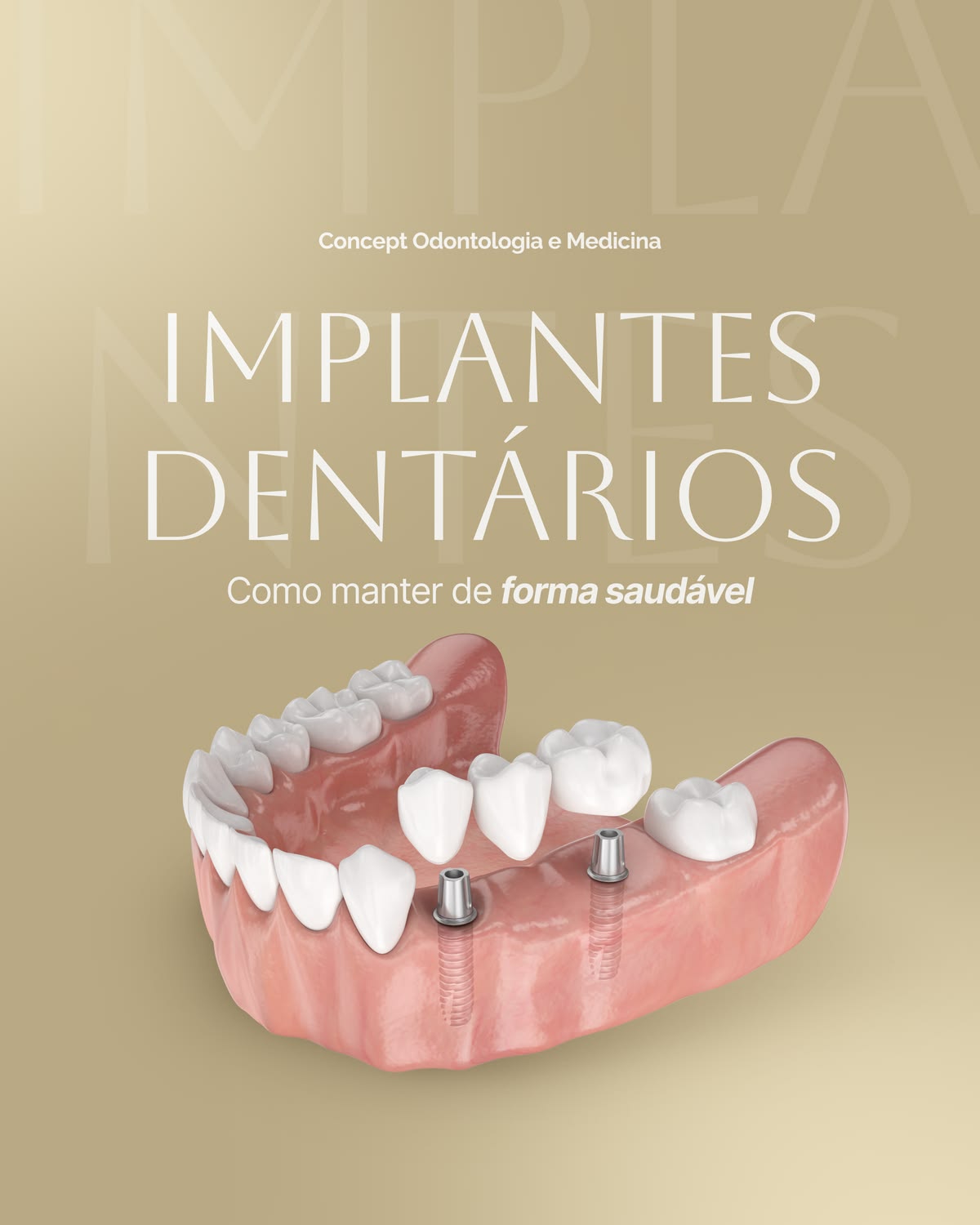 Material ilustrativo sobre implantes dentários da Concept Odontologia